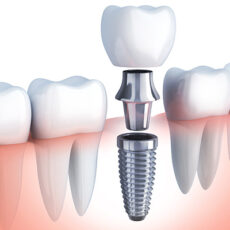 Best Dental Implant Clinic in Greater Noida