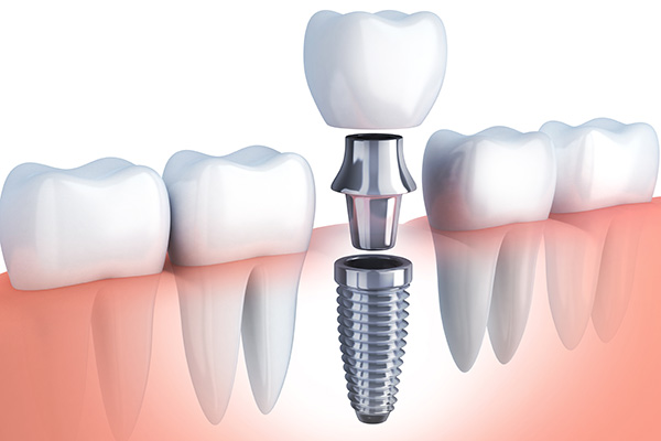 Best Dental Implant Clinic in Greater Noida