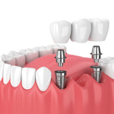 Dental Bridges and Crowns