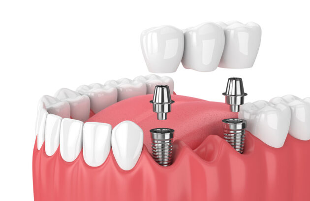 Dental Bridges and Crowns