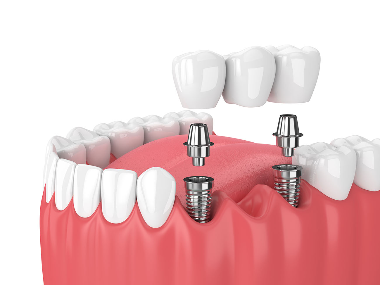 Dental Bridges and Crowns