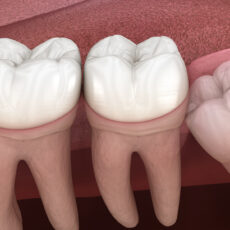 DENTAL IMPACTION