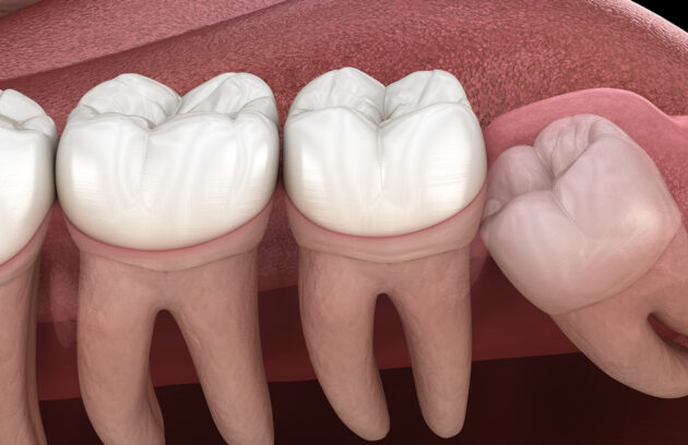 DENTAL IMPACTION