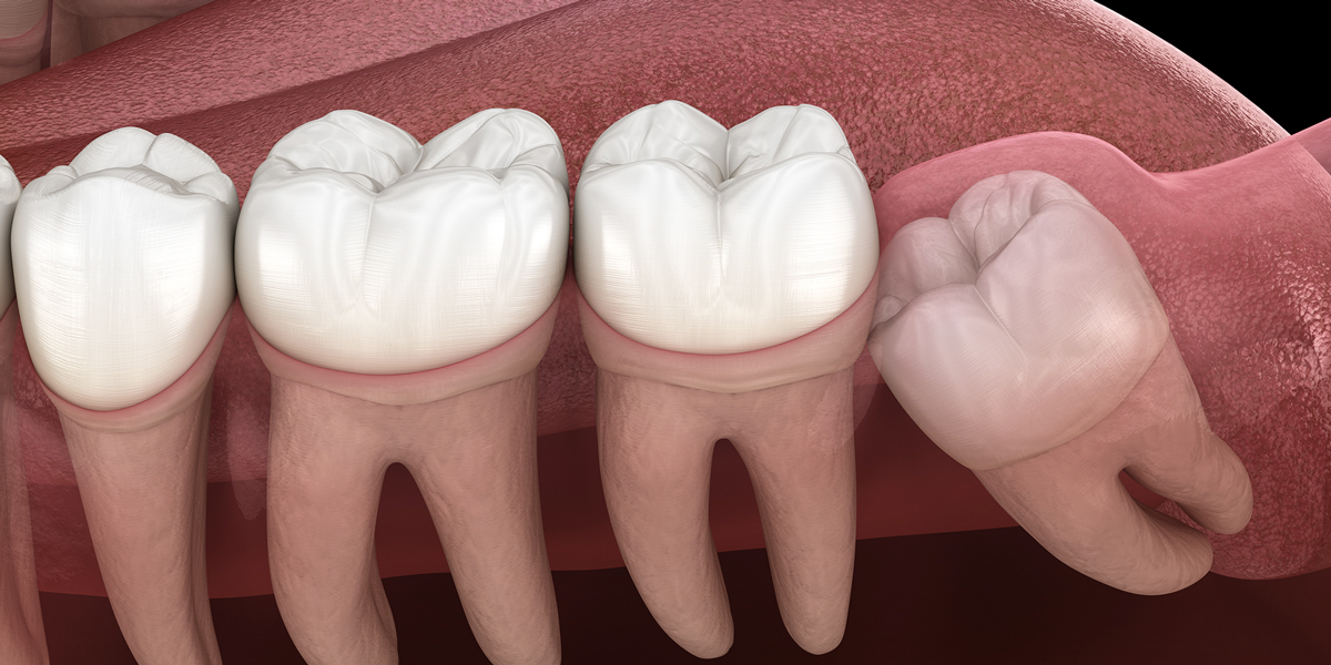 DENTAL IMPACTION