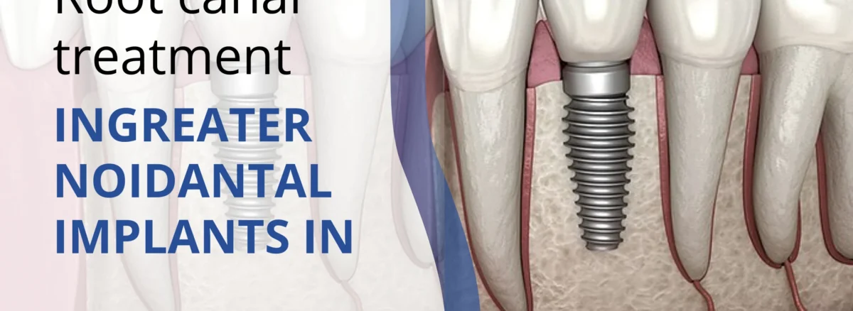 root canal treatment in Greater Noida
